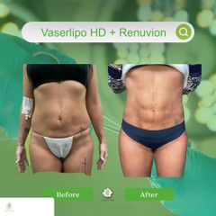 Laserlipolisi - Dott. Umberto Tozzi - Clinique Visage
