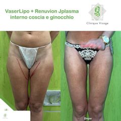 Laserlipolisi - Dott. Umberto Tozzi - Clinique Visage