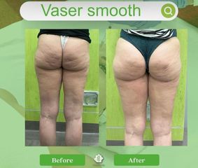 Liposuzione - Dott. Umberto Tozzi - Clinique Visage