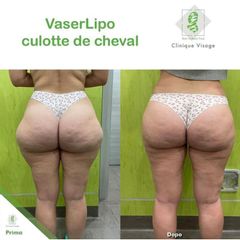Liposuzione - Dott. Umberto Tozzi - Clinique Visage