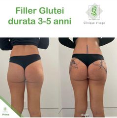 Filler glutei - Dott. Umberto Tozzi - Clinique Visage