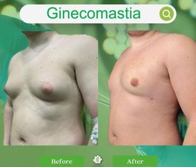 Ginecomastia - Dott. Umberto Tozzi - Clinique Visage