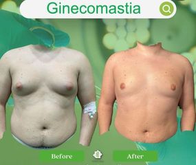 Ginecomastia - Dott. Umberto Tozzi - Clinique Visage