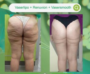 Liposuzione - Dott. Umberto Tozzi - Clinique Visage