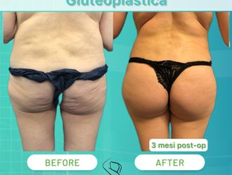 Gluteoplastica prima e dopo - 868962