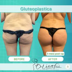 gluteoplastica Dott. Umberto Tozzi