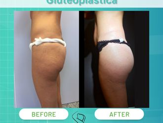 Gluteoplastica prima e dopo - 868963