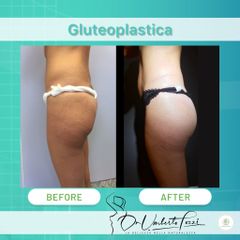 gluteoplastica Dott. Umberto Tozzi