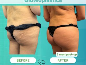 Gluteoplastica prima e dopo - 868964