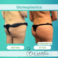 gluteoplastica Dott. Umberto Tozzi