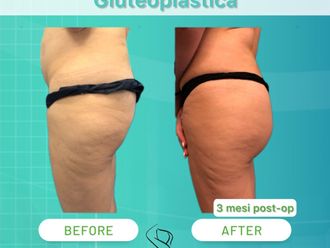 Gluteoplastica prima e dopo - 868965