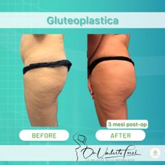 gluteoplastica Dott. Umberto Tozzi