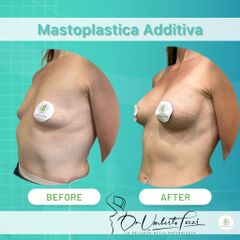 mastoplastica additiva dr tozzi