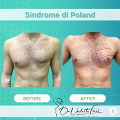 sindrome di poland dr tozzi