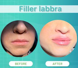 Dott. Umberto Tozzi Filler Labbra