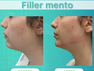 Filler prima e dopo - 874612