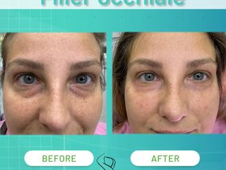 Filler prima e dopo - 874613