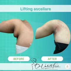 Dott. Umberto Tozzi Lifting Ascellare