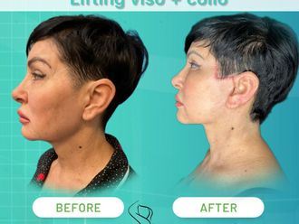 Lifting viso prima e dopo - 874616