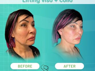 Lifting viso prima e dopo - 874617