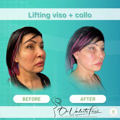 Dott. Umberto Tozzi Lifting viso e collo