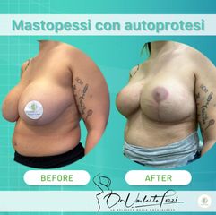 Dott. Umberto Tozzi Mastopessi con autoprotesi