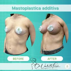 Dott. Umberto Tozzi Mastoplastica Additiva