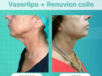 Lipo Vaser prima e dopo - 874622
