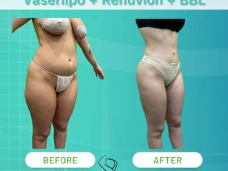 Lipo Vaser prima e dopo - 874624