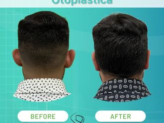 Otoplastica prima e dopo - 874626