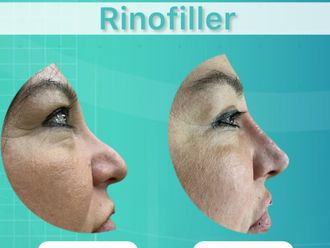 Rinofiller prima e dopo - 874627