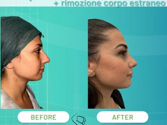 Rinoplastica prima e dopo - 874628