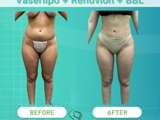 Lipo Vaser prima e dopo - 874629
