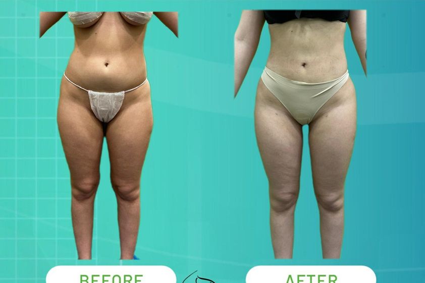 Lipo Vaser prima e dopo - 874629