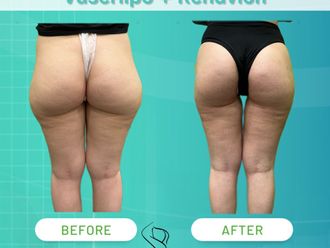 Lipo Vaser prima e dopo - 874630