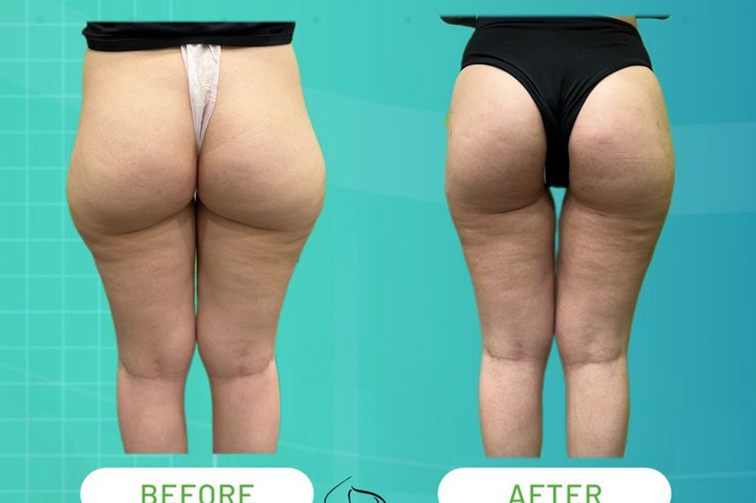 Lipo Vaser prima e dopo - 874630