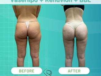Lipo Vaser prima e dopo - 874631