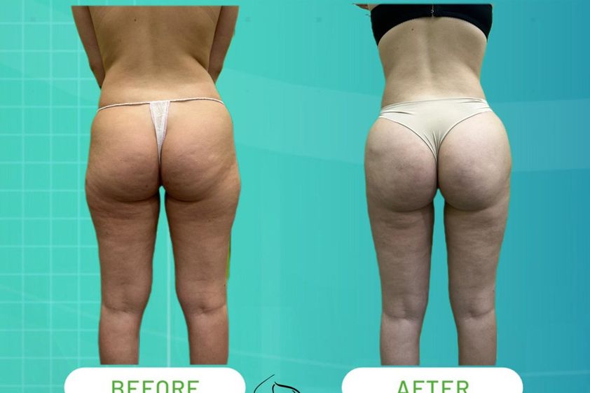 Lipo Vaser prima e dopo - 874631