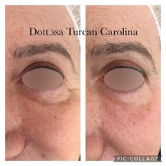 Eliminare occhiaie - Dott.ssa Carolina Turcan