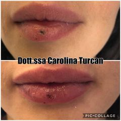 Filler labbra - Dott.ssa Carolina Turcan