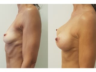 Mastoplastica additiva prima e dopo