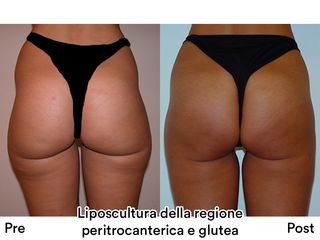 Liposcultura prima e dopo