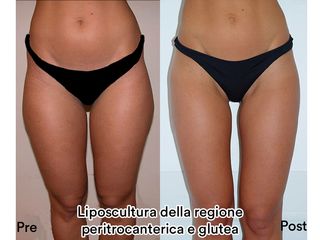 Liposcultura prima e dopo