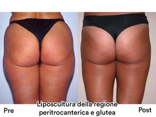 Liposcultura prima e dopo