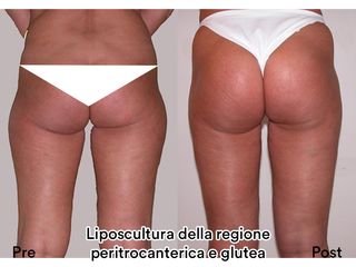 Liposcultura prima e dopo