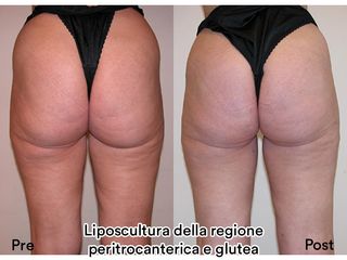 Liposcultura prima e dopo