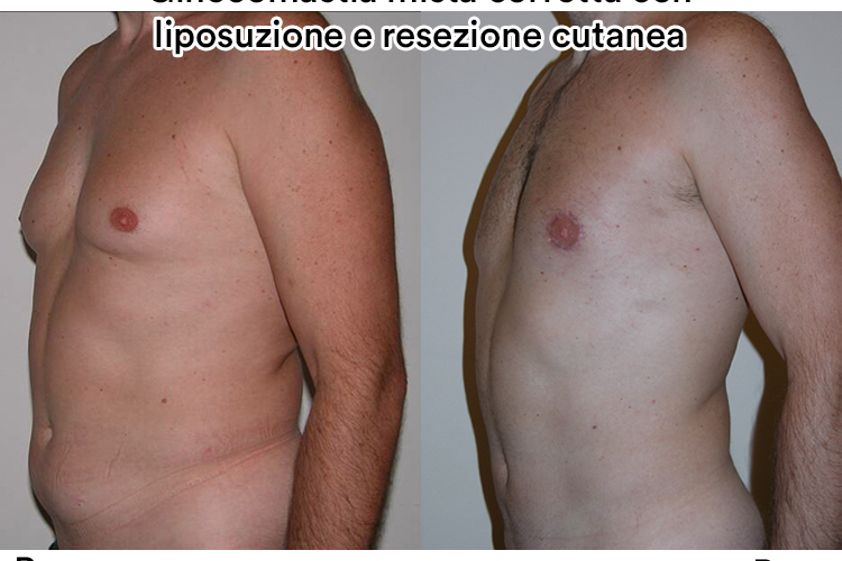 Ginecomastia prima e dopo - 770887