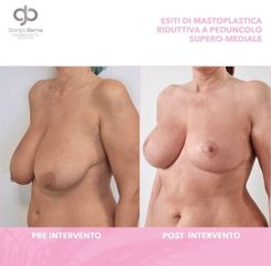 Mastoplastica riduttiva - Dott. Giorgio Berna