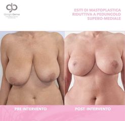 Mastoplastica riduttiva - Dott. Giorgio Berna