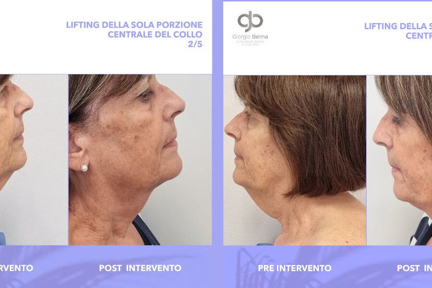 Lifting viso prima e dopo - 873126